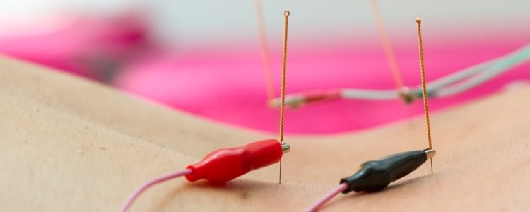 electro-acupuncture-chiropractic-treatment-toronto
