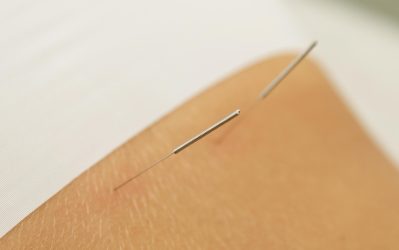 female-back-with-steel-needles-during-procedure-of-acupuncture-therapy-free-photo