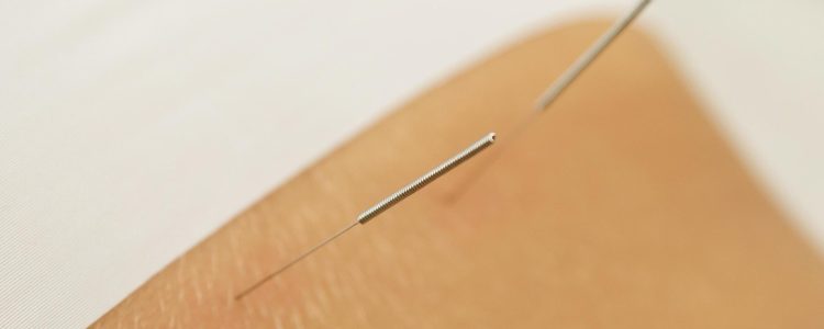 female-back-with-steel-needles-during-procedure-of-acupuncture-therapy-free-photo
