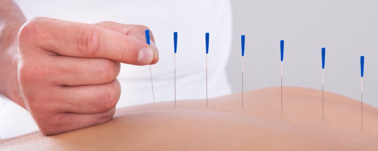 Young,Beautiful,Woman,In,An,Acupuncture,Therapy,In,A,Spa