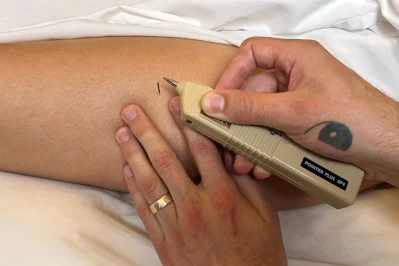 vancouver-sports-acupuncture